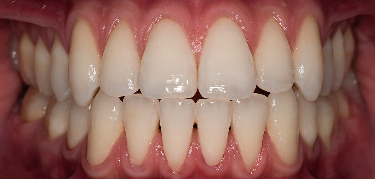 Teeth Whitening Case 13 After