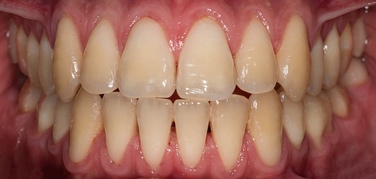 Teeth Whitening Case 13 Before
